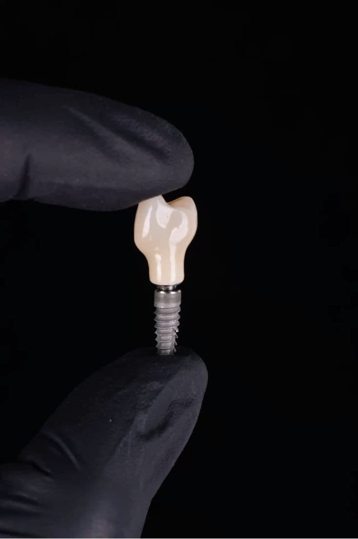 La solución más segura para recuperar tu sonrisa de forma definitiva