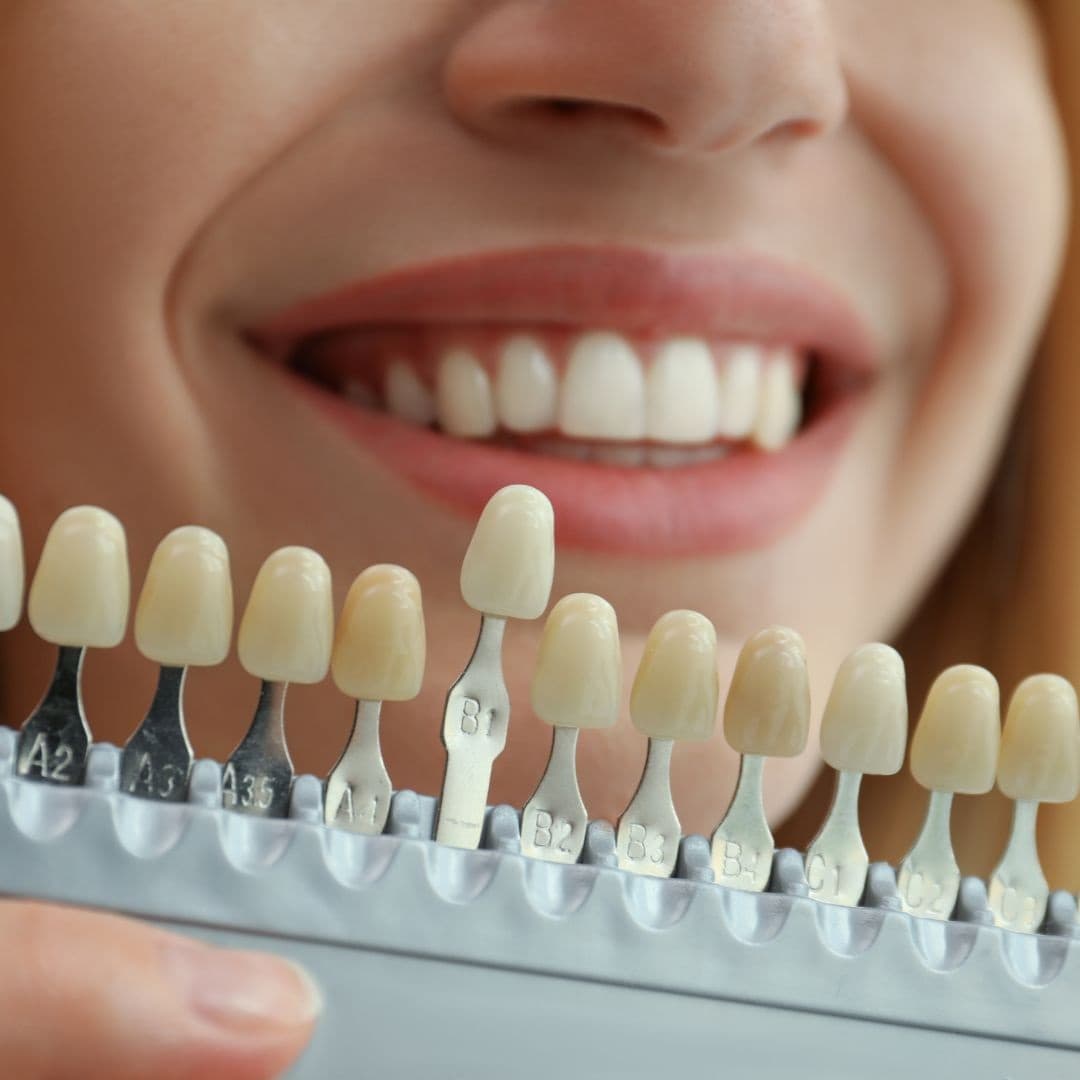 Blanqueamiento Dental en Sant Boi de Llobregat