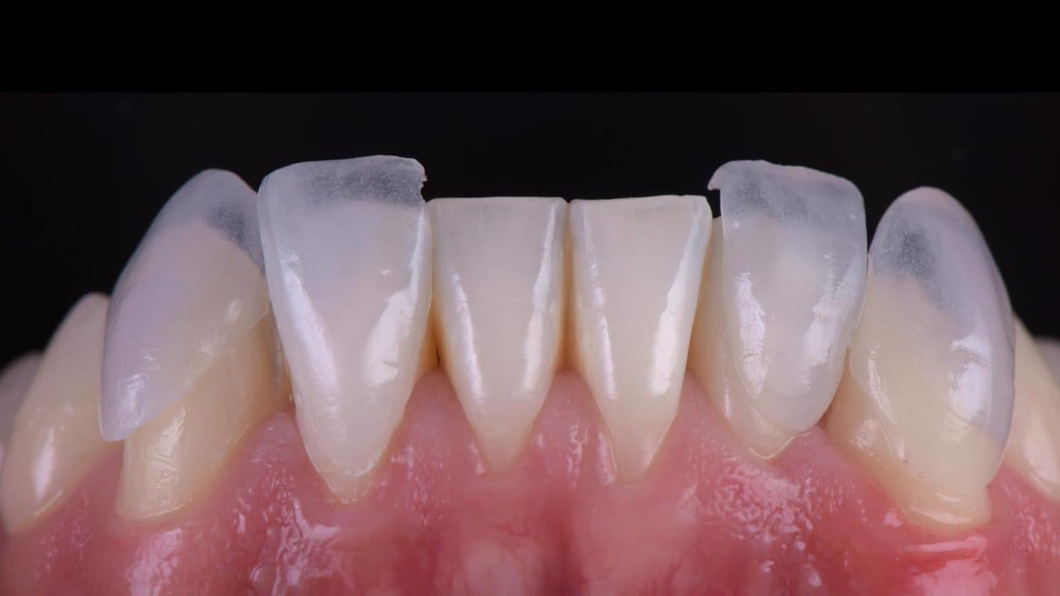 Carillas Dentales en Sant Boi de Llobregat