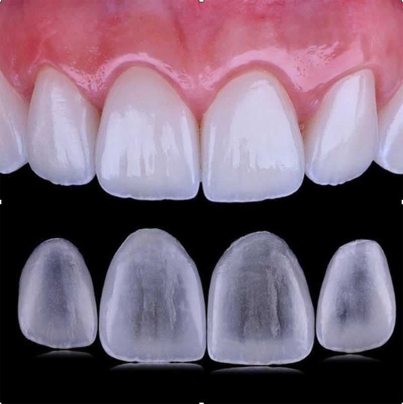 Una sonrisa más armónica con un tratamiento mínimamente invasivo
