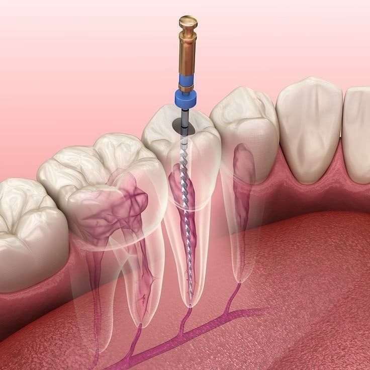 Endodoncia en Sant Boi de Llobregat