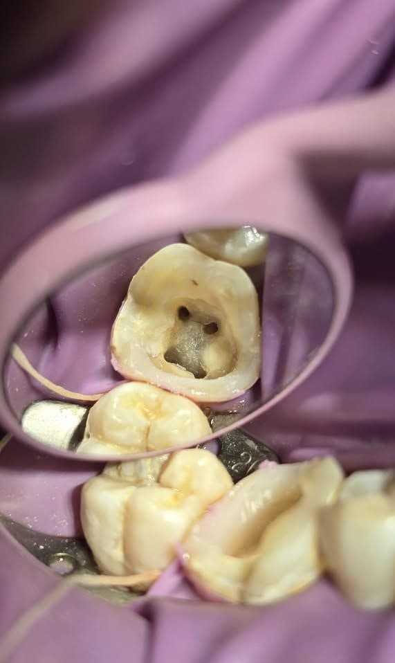 Salvamos dientes que antes era necesario extraer