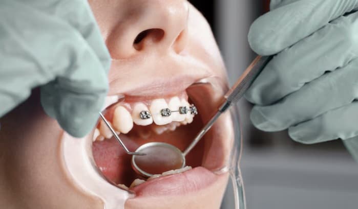 Una sonrisa alineada mejora mucho más que la estética